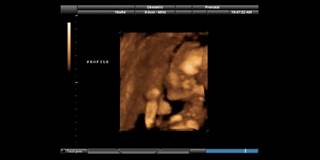 Indirect effects for poor prenatal growth, higher postnatal anger on infant reactivity and regulation Indirect effects for poor prenatal growth, higher postnatal anger on infant reactivity and regulation