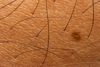 Arthritis Drug Potential Treatment for Alopecia Universalis? Arthritis Drug Potential Treatment for Alopecia Universalis?