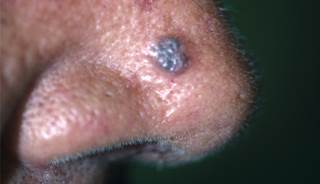 What Are the Two Most Common Skin Cancers? What Are the Two Most Common Skin Cancers?