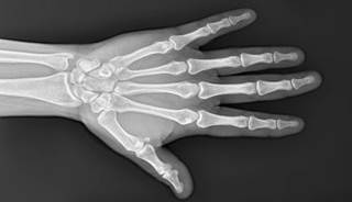 Numbness, Tingling, Weakness, and Coolness in a 'Jammed' Hand Numbness, Tingling, Weakness, and Coolness in a 'Jammed' Hand