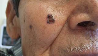 Study shows tumor destruction for eight patients with 10 nodular or superficial BCCs on lower limbs Study shows tumor destruction for eight patients with 10 nodular or superficial BCCs on lower limbs