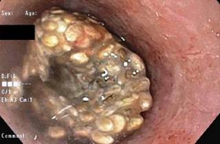Chia Seeds and Dysphagia: A Cautionary Case Study Chia Seeds and Dysphagia: A Cautionary Case Study