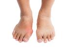 Higher Risk for Stroke, MI in Patients With Gout, Diabetes Higher Risk for Stroke, MI in Patients With Gout, Diabetes