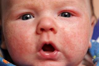Findings based on comparison to standard cow's milk formula in high-risk infants Findings based on comparison to standard cow's milk formula in high-risk infants