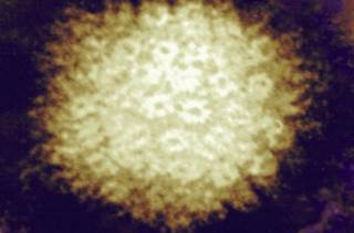 Chickenpox Virus May Cause Strokes in HIV+ Patients Chickenpox Virus May Cause Strokes in HIV+ Patients