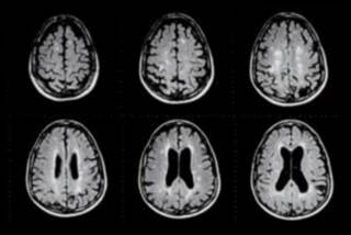 MRI: A Critical Player in Guiding Clinical Decisions in MS MRI: A Critical Player in Guiding Clinical Decisions in MS