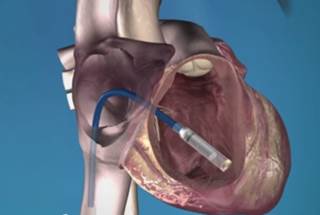 'World's Smallest Pacemaker' Appears Promising 'World's Smallest Pacemaker' Appears Promising