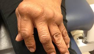 New Blood Test May Identify RA Risk Years Before Onset New Blood Test May Identify RA Risk Years Before Onset