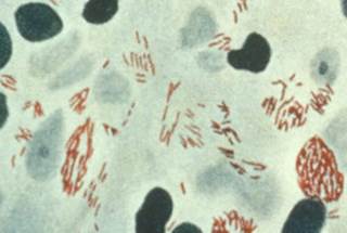 Why Are Leprosy Cases Increasing in FL? Why Are Leprosy Cases Increasing in FL?