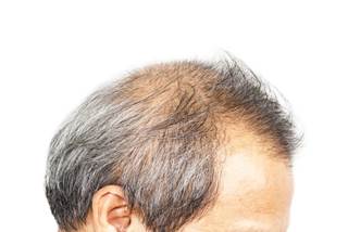 Link for perifollicular scaling and presence of any type of dystrophic hair with positive culture Link for perifollicular scaling and presence of any type of dystrophic hair with positive culture