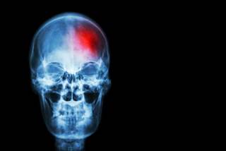 Task-oriented rehabilitation no better than equivalent or lower dose occupational therapy Task-oriented rehabilitation no better than equivalent or lower dose occupational therapy