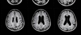 Imaging revealed widespread lesions in the white matter of MS patients Imaging revealed widespread lesions in the white matter of MS patients
