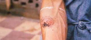 There are currently no other approved drugs to treatment cutaneous or mucosal leishmaniasis There are currently no other approved drugs to treatment cutaneous or mucosal leishmaniasis