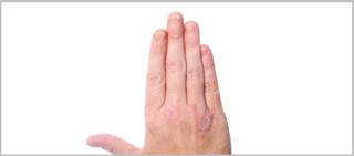 Incidence, Risk Factors for Psoriatic Arthritis in Psoriasis Patients Incidence, Risk Factors for Psoriatic Arthritis in Psoriasis Patients