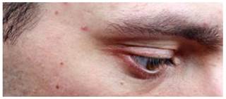 Long-term oral macrolides for treatment of acne may increase macrolide resistance Long-term oral macrolides for treatment of acne may increase macrolide resistance