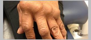 Findings based on patients with previous inadequate response to biologics Findings based on patients with previous inadequate response to biologics