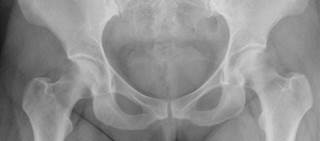 The submission is based on a Phase 3 trial in 7,180 postmenopausal women with osteoporosis The submission is based on a Phase 3 trial in 7,180 postmenopausal women with osteoporosis