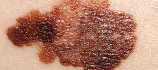Compound annual growth rate: 0.9% in raw incidence, 3.0% in in situ melanoma incidence Compound annual growth rate: 0.9% in raw incidence, 3.0% in in situ melanoma incidence