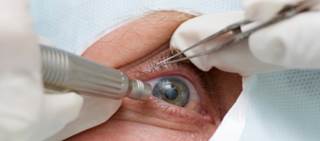 Outcomes similar for femtosecond laser-assisted, phacoemulsification cataract surgery Outcomes similar for femtosecond laser-assisted, phacoemulsification cataract surgery