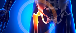 Bone density, corticosteroid use, and previous fracture were the major deciding factors for doctors Bone density, corticosteroid use, and previous fracture were the major deciding factors for doctors