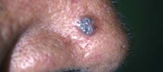 Physicians shouldn't rely on mole count as the only reason to perform skin exams Physicians shouldn't rely on mole count as the only reason to perform skin exams