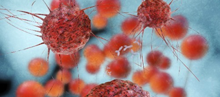 Researchers found longer survival with hyperthermic intraperitoneal chemotherapy in stage III epithelial ovarian cancer Researchers found longer survival with hyperthermic intraperitoneal chemotherapy in stage III epithelial ovarian cancer