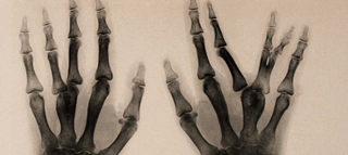 burns archive x-ray fused meta burns archive x-ray fused meta