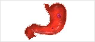 Fifty-five trials involving peptic ulcer treatment in H. pylori-positive adults were selected for review Fifty-five trials involving peptic ulcer treatment in H. pylori-positive adults were selected for review