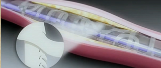 In patients with intraprocedural stent thrombosis during percutaneous coronary intervention In patients with intraprocedural stent thrombosis during percutaneous coronary intervention