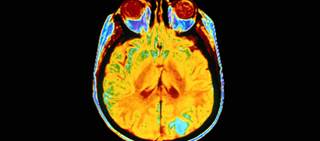 Discovery might eventually lead to better treatment for glioblastoma multiforme Discovery might eventually lead to better treatment for glioblastoma multiforme