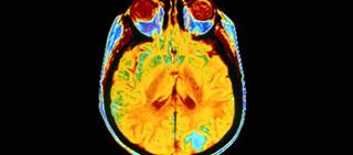 Selumetinib Active in Children With Neurofibromatosis Type 1 Selumetinib Active in Children With Neurofibromatosis Type 1