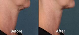 kybella image kybella image
