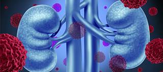 Overall survival, objective response higher than sunitinib for untreated clear-cell advanced RCC Overall survival, objective response higher than sunitinib for untreated clear-cell advanced RCC