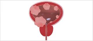 Androgen suppression therapy may be prophylactic for intravesical recurrence of bladder cancer Androgen suppression therapy may be prophylactic for intravesical recurrence of bladder cancer