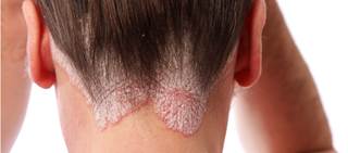 A total of 102 patients with scalp psoriasis and without body psoriasis took part in the study A total of 102 patients with scalp psoriasis and without body psoriasis took part in the study