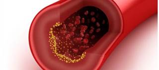 Increased risk for cardiovascular events and all-cause mortality for patients with type 2 diabetes Increased risk for cardiovascular events and all-cause mortality for patients with type 2 diabetes