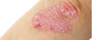 The spray is indicated for the treatment of plaque psoriasis in adults The spray is indicated for the treatment of plaque psoriasis in adults