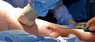 Large improvement in daytime sleepiness with surgical weight loss interventions Large improvement in daytime sleepiness with surgical weight loss interventions