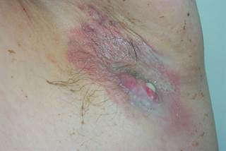 Bermekimab was well-tolerated with no safety concerns. Bermekimab was well-tolerated with no safety concerns.