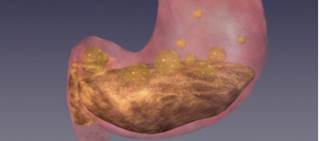 A total of 205 adult women with diabetic gastroparesis were included in the trial A total of 205 adult women with diabetic gastroparesis were included in the trial