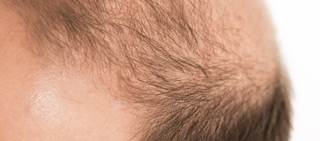 Significant increases in total hair count, total hair density, terminal hair density after 180 days Significant increases in total hair count, total hair density, terminal hair density after 180 days