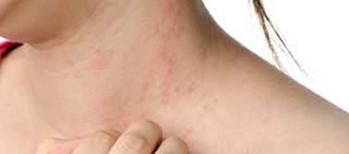 Intradermal flu vaccine response reduced with atopic dermatitis Intradermal flu vaccine response reduced with atopic dermatitis