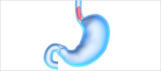 Biomarker-based non-endoscopic method detects BE based on methylated <i>CCNA1</i> and <i>VIM</i> DNA Biomarker-based non-endoscopic method detects BE based on methylated <i>CCNA1</i> and <i>VIM</i> DNA