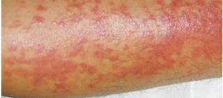 Significant decrease in rate of sebum production in patients receiving low-dose oral isotretinoin Significant decrease in rate of sebum production in patients receiving low-dose oral isotretinoin