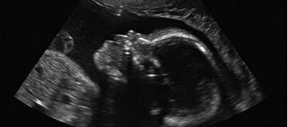 Greater depth in first trimester versus developmental delay group, typical development group Greater depth in first trimester versus developmental delay group, typical development group