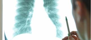 PUR1900 is an inhaled antifungal which combines itraconazole and Pulmatrix's iSPERSE technology PUR1900 is an inhaled antifungal which combines itraconazole and Pulmatrix's iSPERSE technology