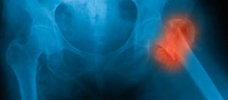 No increase in risk of any fracture, osteoporotic or hip fractures with continuous long-term use No increase in risk of any fracture, osteoporotic or hip fractures with continuous long-term use