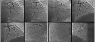 CMR is better for reducing unnecessary angiography compared with NICE guideline-directed care CMR is better for reducing unnecessary angiography compared with NICE guideline-directed care