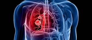 Significant prognostic factors include four factors from earlier index, plus <i>EGFR</i> and <i>ALK</i> alterations Significant prognostic factors include four factors from earlier index, plus <i>EGFR</i> and <i>ALK</i> alterations