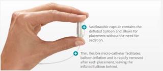 The Obalon is a swallowable intragastric that consists of a balloon folded inside a capsule The Obalon is a swallowable intragastric that consists of a balloon folded inside a capsule